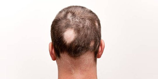 Menyingkap Misteri Kehilangan Rambut Karena Alopecia Areata